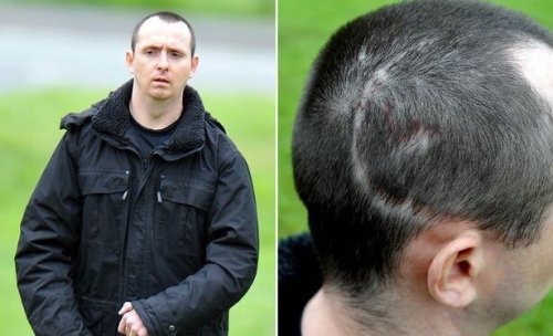 폴은 뇌손상으로 병적인 웃음 증상을 보였다