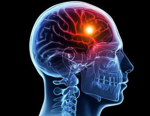 뇌졸중의 원인과 유형