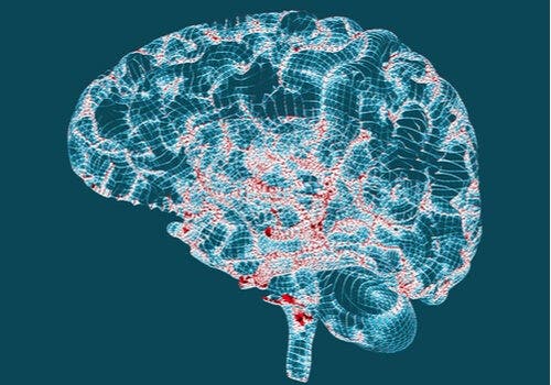 헌팅턴병의 특성과 징후