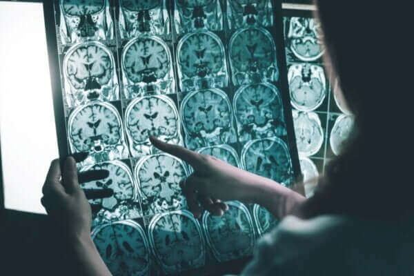 알츠하이머병 환자를 위한 뇌파 자극